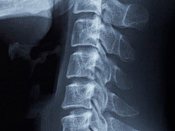 X-ray 촬영