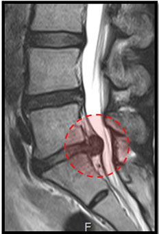 디스크 MRI