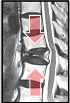 압박골절 MRI