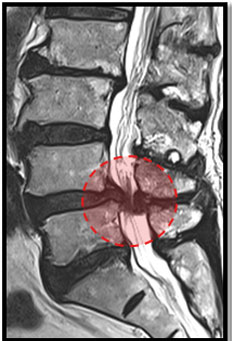 협착증 MRI